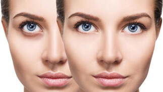 Indiba deep beauty + presoterapia ocular Iridium Baldan Group + velo de colágeno e hialurónico